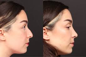 Rhinoplasty