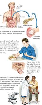 The pancreas is in a deep area of the. Pancreatic Cancer Upper Gi Cancers Spectrum Health