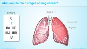 Unfortunately, a status of ned is not the same as cured because in advanced lung cancer, there can always be microscopic cancer cells present that go undetected on a scan. Slide Show Staging Of Lung Cancer