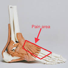 If your physician assumes a broken bone, fracture, or bone spurs. Extensor Tendonitis Tendinopathy Sports Physiotherapy Stefan Duell Facebook
