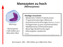 Monozyten Zu Hoch Monozytose Ursachen