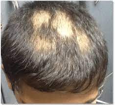 The hair loss can be isolated to your beard, or it can occur in other. Thirteen Years Male With Multiple Patches Of Hair Loss So Called Download Scientific Diagram