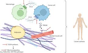 Image result for Cachexia in Cancer