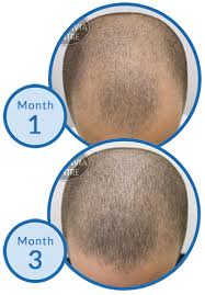 Giroud hairstyle olivier new fade haircut please enjoy my highly reed tutorial of french national football player picture the hearts. Olivier Giroud Going Bald After World Cup Winning Bet