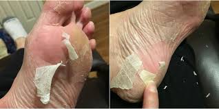 Here is a list of remedies with natural ingredients mostly available at home. Baby Foot Peel Review What To Know About Baby Foot Peel And If It S Safe