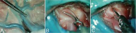 Women tend to have higher rates of aneurysms than men. Learning Brain Aneurysm Microsurgical Skills In A Human Placenta Model Predictive Validity In Journal Of Neurosurgery Volume 128 Issue 3 2017