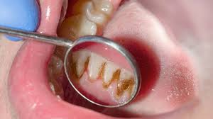 Image result for Gingivitis