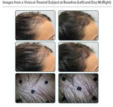 It has been gaining in popularity recently. Viviscal Dallas Hair Growth Supplement Plano Tx