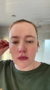 Post laser eye surgery complications? #lasereyesurgery #lasek #laserey...