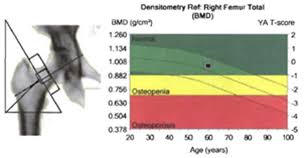 can a dxa scan determine my risk for osteoporosis wake