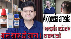 Dhi hair loss treatment in india is the most trusted hair loss solution for people from all walks of life. Homeopathic Medicine For Alopecia Areata Explain Everything Permanent Result Youtube