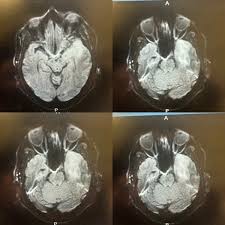 Image result for HSV Encephalitis