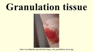 We did not find results for: Granulation Tissue Youtube