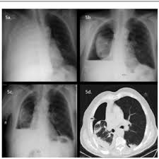 But, if you find an area of thickening inflammatory breast cancer tends to strike five years earlier, on average, than other types of breast cancer, and it might not show up on a mammogram. P A Chest X Ray Images Of The Patient With Breast Cancer A Before Download Scientific Diagram