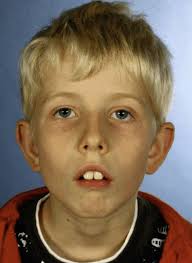 If I started mouth breathing at 15, will it change my facial features?