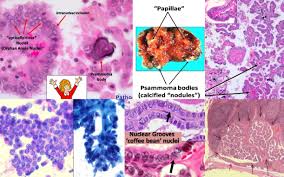 Follicular carcinoma of thyroid, 5. Disorders Of The Thyroid Gland Flashcards Memorang