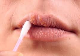 Modrica postaje veća, odlazi u druga područja; Cvor Zeljeznicki Diskretan Ulje Peperminta Za Herpes Na Usnama Chacampuslantern Org