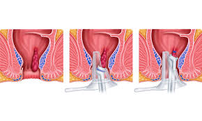 Image result for Hemorrhoid