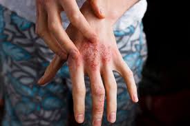 Eczema can usually be diagnosed based on its appearance. Biologic Clears Severe Dermatitis Of The Hands
