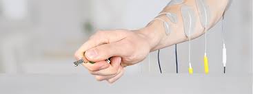 Carpal Tunnel Syndrome Causes Symptoms Treatment Etc Stiwell