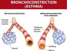 Asthma: Symptoms, Complications, And Treatment