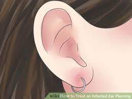 Treat An Infected Ear Piercing Infected Ear Piercing Ear Piercings Ear Piercing Care