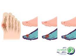 علاج انحراف اصبع القدم الكبير | د ابراهيم حنتيرة أفضل دكتور جراحة عظام