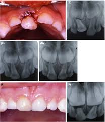 Image result for Tooth Luxation