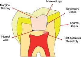 Composite fibers are built up of two or more different components, which can be of inorganic and organic origin. The Use Of Bioactive Glass Bag In Dental Composites A Critical Review Sciencedirect