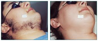 If you're thinking about having the treatment, it pays to know the facts so there are so many pros to getting laser beyond just the hair removal aspect. Laser Hair Removal In Pembroke Pines