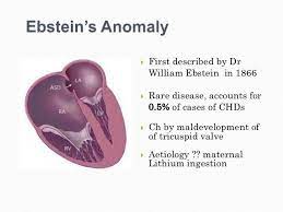 Anomaly has been reported rarely.4 the risk of ebstein's. 24 Ebstein S Anamoly Ideas Ebstein S Anomaly Tricuspid Valve Heart Defect