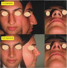 What a deviated septum looks like. Patient With Dorsal Nasal Hump And Deviated Septum Download Scientific Diagram