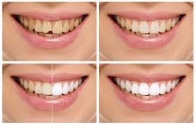 Cosmetic dentistry near me in fresno, ca. All About Cosmetic Dentistry Tooth Care Clinic Dental Implant Centre