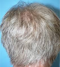 Repopulation Of Hair After One Year Of Treatment With Interferon Alpha Download Scientific Diagram