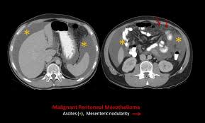 Peritoneal mesothelioma does not tend to . Epos Trade
