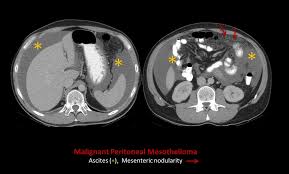 The ct findings were evaluated for the morphologic appearance of. Epos Trade