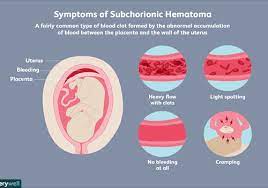 Maybe you would like to learn more about one of these? Subchorionic Hematoma And Pregnancy Risks
