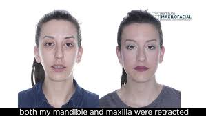 JESSICA: Class II, long face, biretrusion, open bite