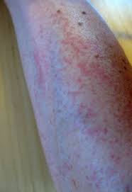 An itchy mouth is a common symptom. Garden Rash Popsugar Fitness