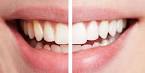 Bicarbonate sur les dents