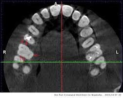 For all statistical analyses used p < 0.05, a positive correlation was observed between the severity of class ii malocclusion and the mesiopalatal rotation of the maxillary first molar. Endodontic Treatment Of The Maxillary First Molar With Five Root Canals Three Case Reports Revista Portuguesa De Estomatologia Medicina Dentaria E Cirurgia Maxilofacial