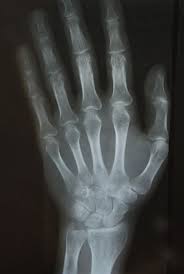 X Ray Report Problem Photo Dictionary X Ray Presents For Boyfriend