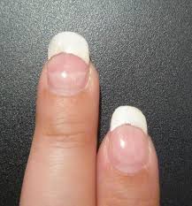 Im nägel & nageldesign forum im bereich fashion & lifestyle; Nagel Losen Sich Am Nagelbett Wieder Ab