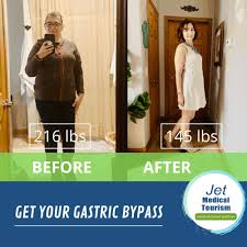 After hearing her story about life before and after gastric bypass surgery, i knew she had to share her journey with the world. Gastric Bypass Before And After Pictures Best Photos 2020