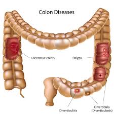 There's no cure for ulcerative colitis. Ulcerative Colitis Jackson Siegelbaum Gastroenterology