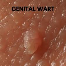Image result for genital warts