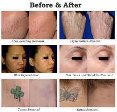 Laser tattoo removal in waterbury on yp.com. Pico Laser Tattoo Removal