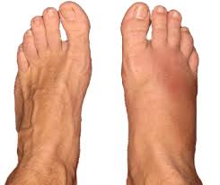 Stress Fractures Of The Foot Why Is My Foot Swollen Stress Fracture Hairline Fracture Fracture
