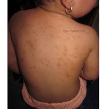 Image result for Urticaria pigmentosa children