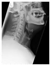 Image result for Tonsillolith